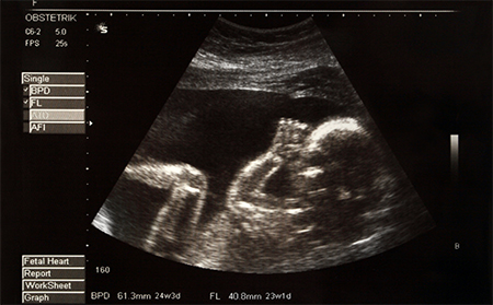 ultrasound of a baby in the womb